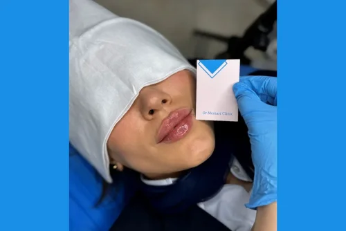 تاثیر فیلر لب بر زیبایی صورت