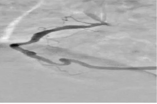 امکان افزایش دقت نمایش عروق کرونری قلب با روشهای مبتنی بر هوش مصنوعی