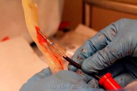 راه اندازی بانك خون بند ناف در خارج كشور، ذخیره نمونه خارجی